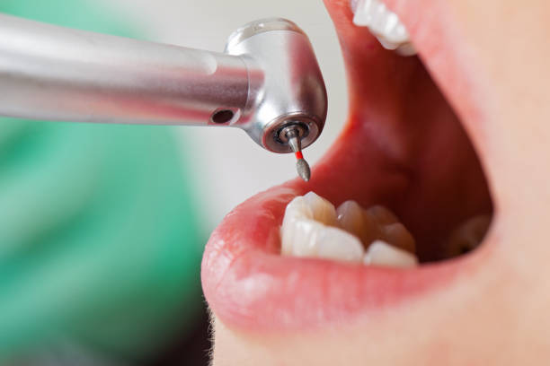 Best Broken or Cracked Tooth Emergency Dentist in Townsend, MT